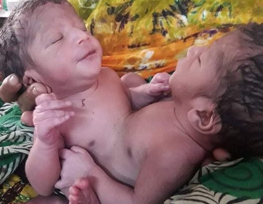 চাঁপাইনবাবগঞ্জে জন্মগত পেট জোড়া লাগানো যমজ শিশু দুটি মারা গেছেন