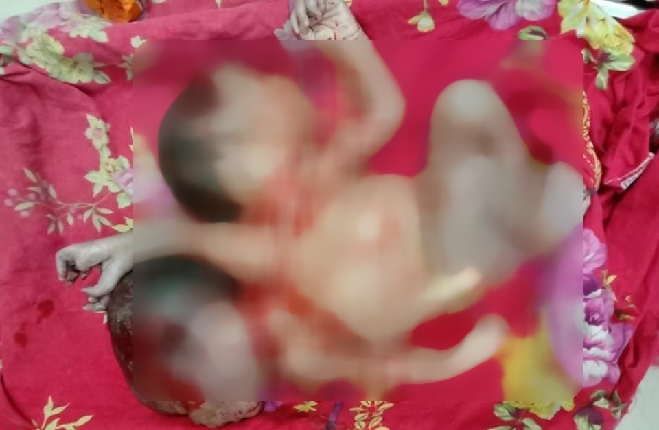 চাঁপাইনবাবগঞ্জের শিবগঞ্জে অস্বাভাবিক দুই মাথার মৃত শিশুর জন্ম