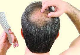 মানুষের শরীরের অন্যতম আকর্ষণ চুল পড়া সমস্যার সমাধান হবে তেলেই