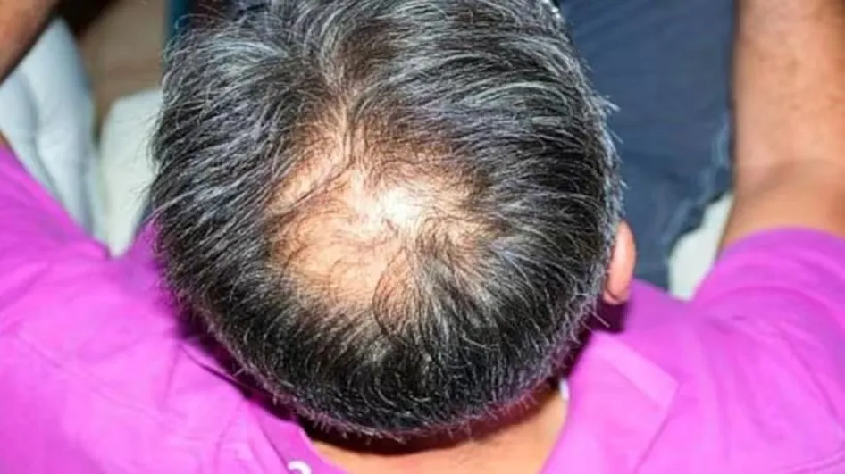 মাথা ক্রমশ টাক পড়ছে? রোজ এই ৬ ব্যায়ামে গজাতে পারে চুল